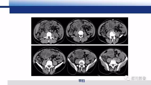 【PPT】腹膜解剖及炎性病变影像诊断