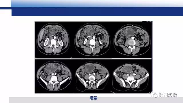 【PPT】腹膜解剖及炎性病变影像诊断