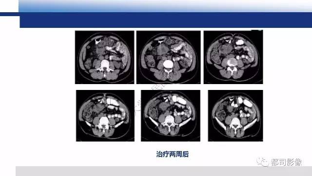 【PPT】腹膜解剖及炎性病变影像诊断