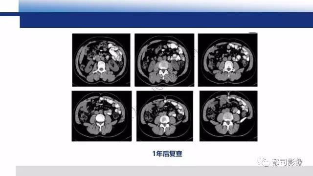 【PPT】腹膜解剖及炎性病变影像诊断
