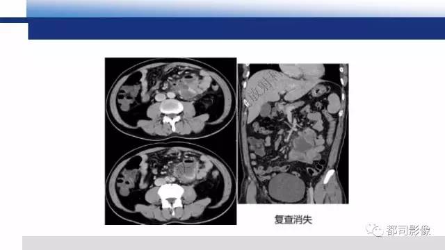 【PPT】腹膜解剖及炎性病变影像诊断