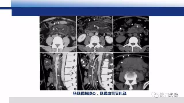 【PPT】腹膜解剖及炎性病变影像诊断