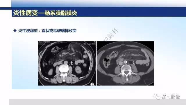 【PPT】腹膜解剖及炎性病变影像诊断