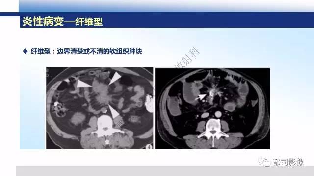 【PPT】腹膜解剖及炎性病变影像诊断
