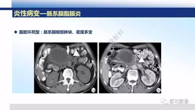 【PPT】腹膜解剖及炎性病变影像诊断