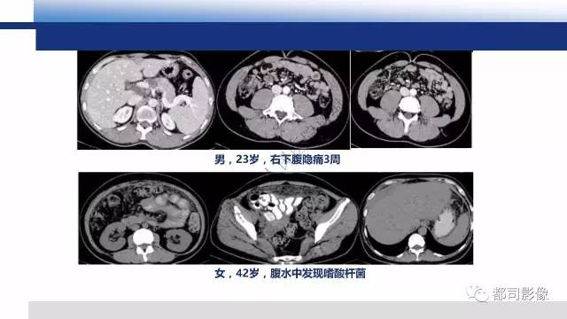 【PPT】腹膜解剖及炎性病变影像诊断