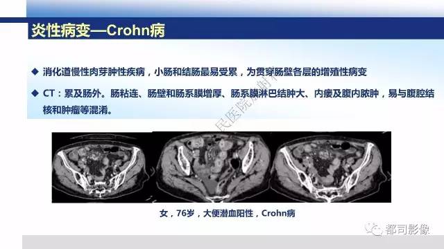 【PPT】腹膜解剖及炎性病变影像诊断