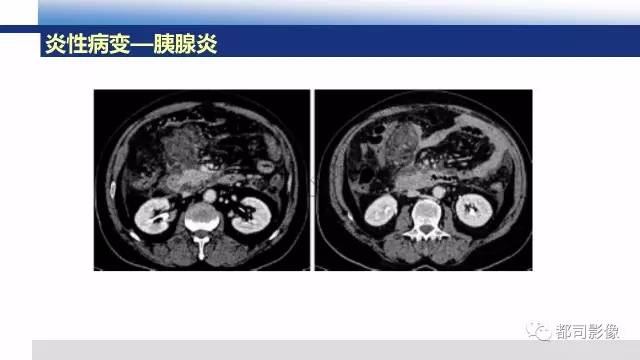 【PPT】腹膜解剖及炎性病变影像诊断