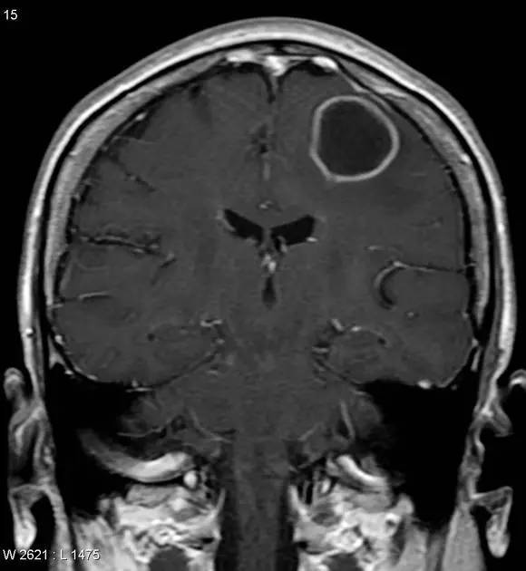 颅内常见环形强化病变汇总 颅内常见环形强化病变汇总