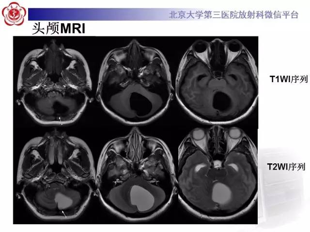 【病例】小脑血管母细胞瘤