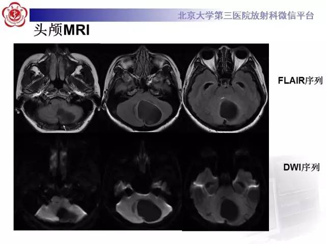 【病例】小脑血管母细胞瘤