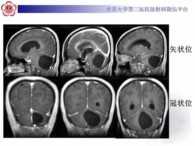 【病例】小脑血管母细胞瘤