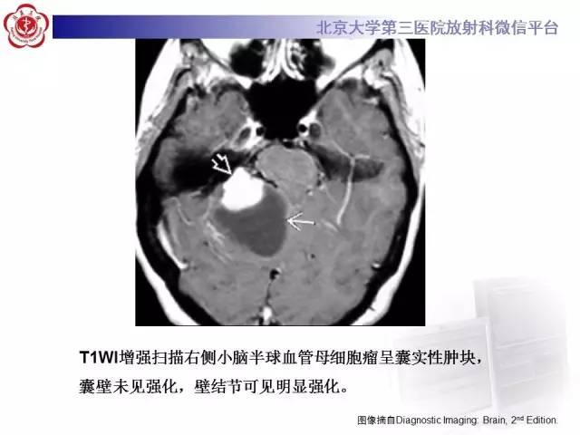 【病例】小脑血管母细胞瘤
