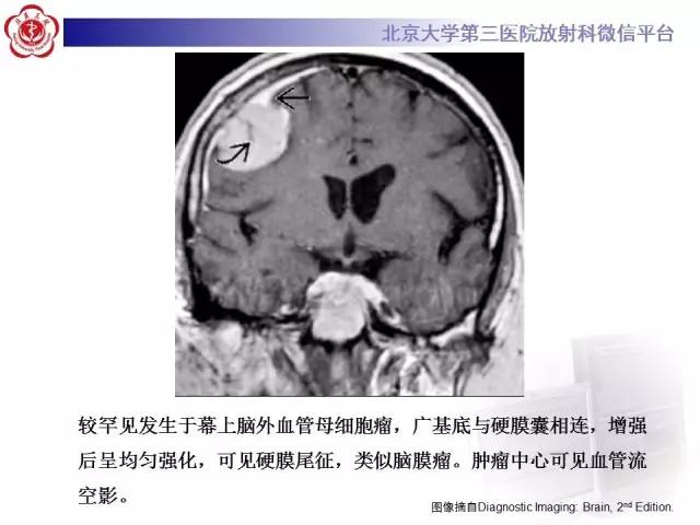 【病例】小脑血管母细胞瘤
