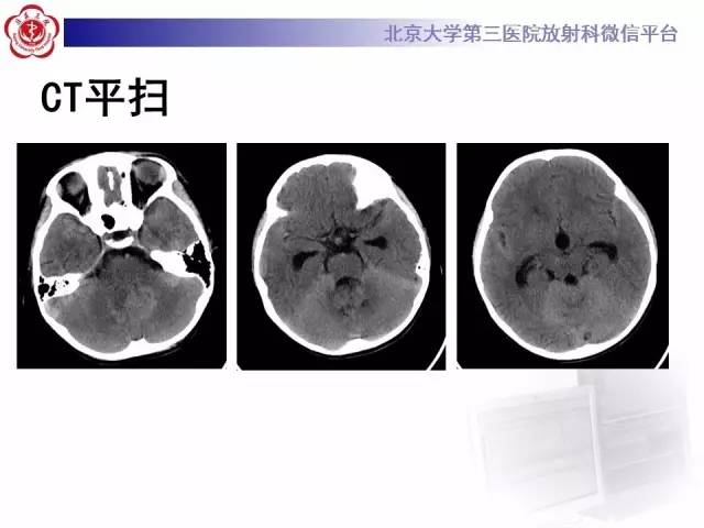 【病例】小脑血管母细胞瘤