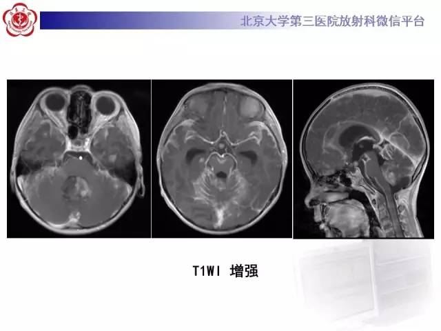 【病例】小脑血管母细胞瘤