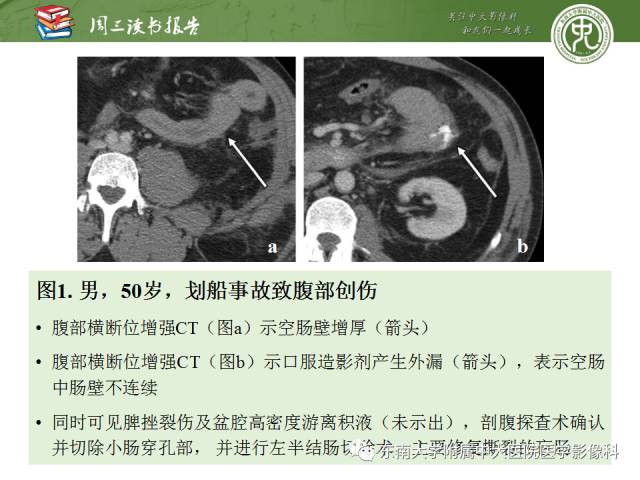 【PPT】经手术证实的肠管及肠系膜钝性损伤的CT表现