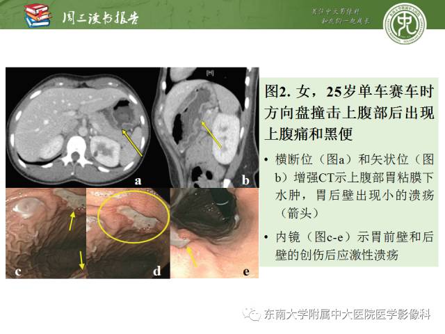 【PPT】经手术证实的肠管及肠系膜钝性损伤的CT表现