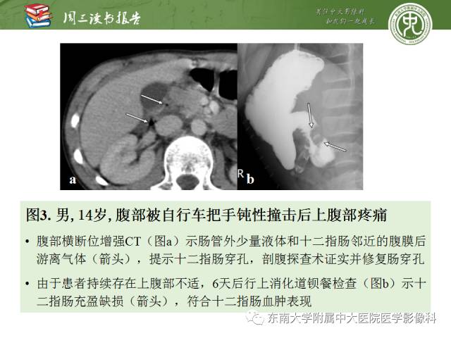 【PPT】经手术证实的肠管及肠系膜钝性损伤的CT表现