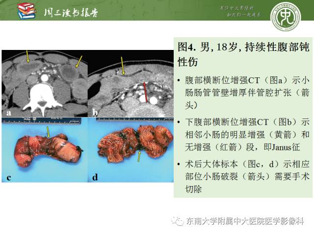 【PPT】经手术证实的肠管及肠系膜钝性损伤的CT表现