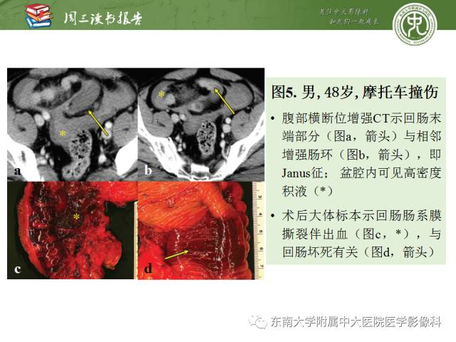 【PPT】经手术证实的肠管及肠系膜钝性损伤的CT表现