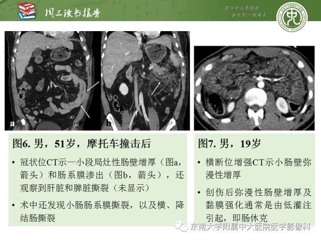 【PPT】经手术证实的肠管及肠系膜钝性损伤的CT表现