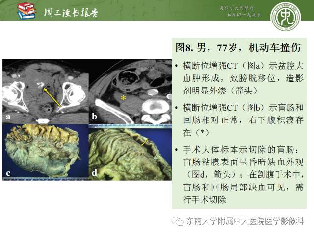 【PPT】经手术证实的肠管及肠系膜钝性损伤的CT表现