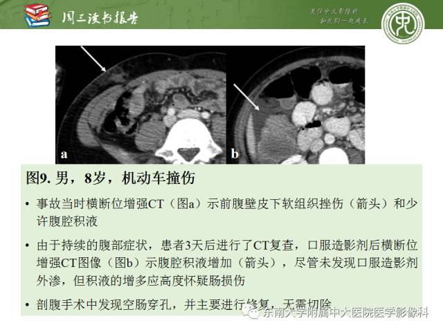 【PPT】经手术证实的肠管及肠系膜钝性损伤的CT表现