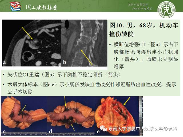 【PPT】经手术证实的肠管及肠系膜钝性损伤的CT表现