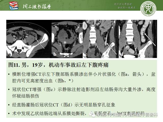 【PPT】经手术证实的肠管及肠系膜钝性损伤的CT表现