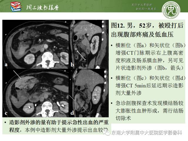 【PPT】经手术证实的肠管及肠系膜钝性损伤的CT表现
