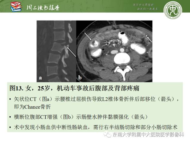 【PPT】经手术证实的肠管及肠系膜钝性损伤的CT表现