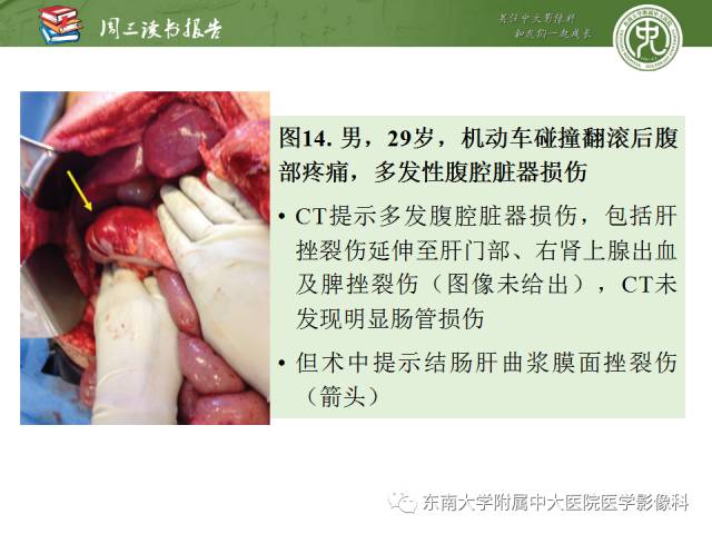 【PPT】经手术证实的肠管及肠系膜钝性损伤的CT表现