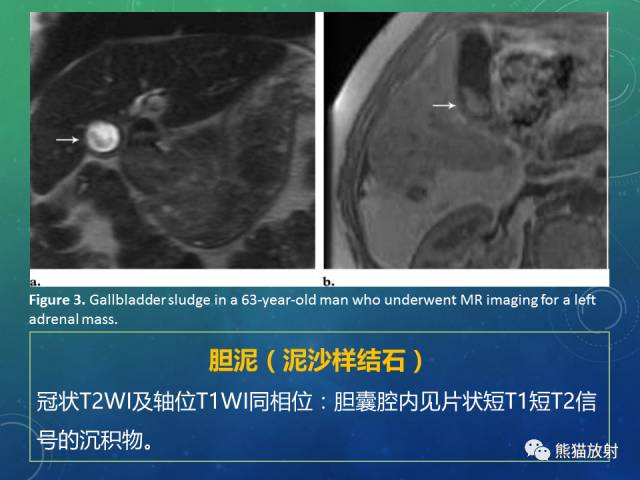 【PPT】正常胆囊及胆囊病变的MRI表现
