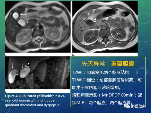 【PPT】正常胆囊及胆囊病变的MRI表现