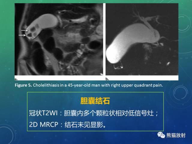 【PPT】正常胆囊及胆囊病变的MRI表现