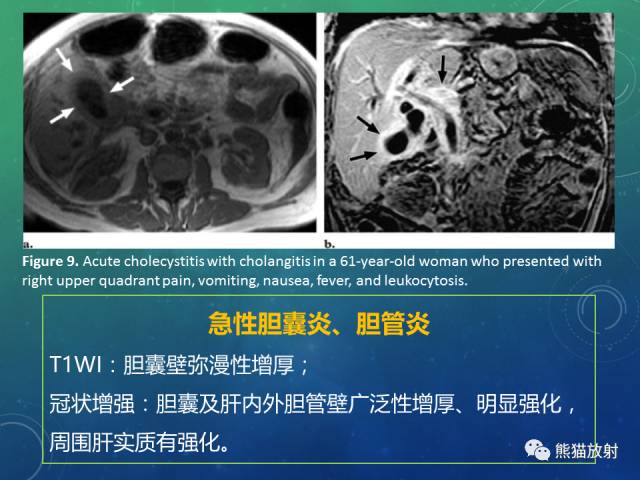 【PPT】正常胆囊及胆囊病变的MRI表现