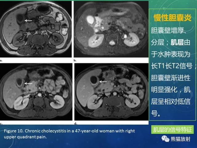 【PPT】正常胆囊及胆囊病变的MRI表现