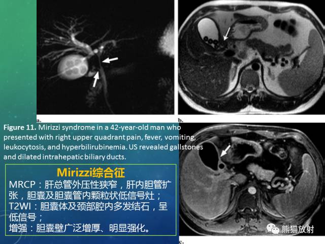 【PPT】正常胆囊及胆囊病变的MRI表现