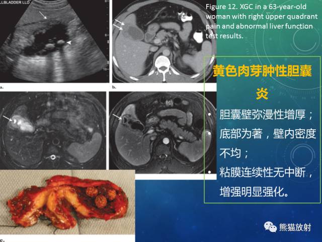 【PPT】正常胆囊及胆囊病变的MRI表现