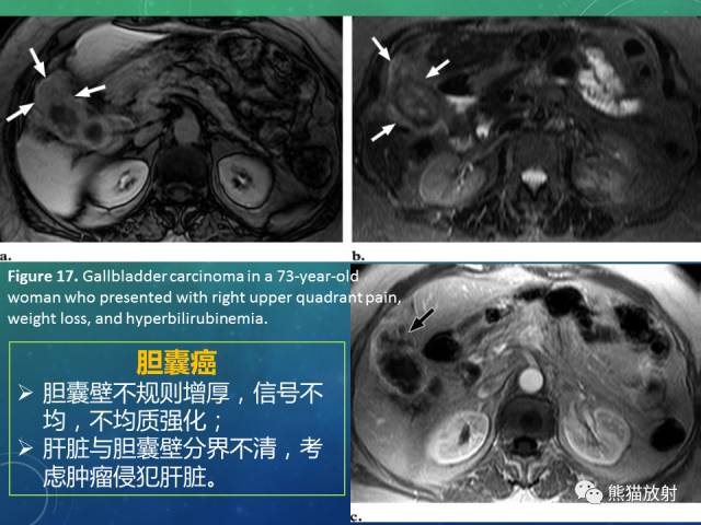 【PPT】正常胆囊及胆囊病变的MRI表现