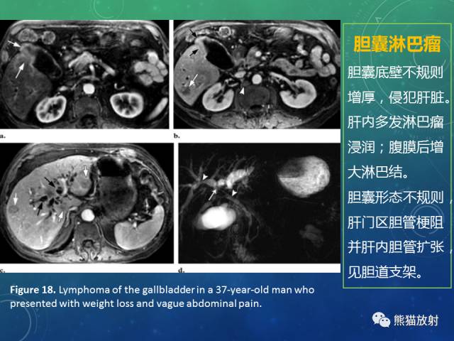 【PPT】正常胆囊及胆囊病变的MRI表现