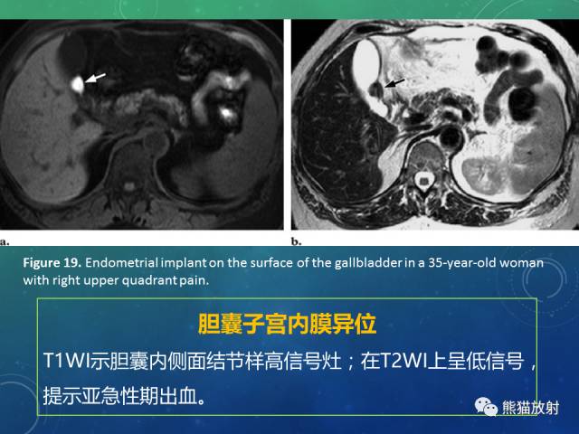 【PPT】正常胆囊及胆囊病变的MRI表现