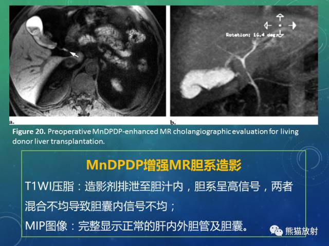 【PPT】正常胆囊及胆囊病变的MRI表现