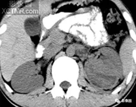 【病例】左肾撕裂伤伴包膜下血肿1例CT