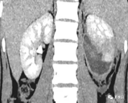 【病例】左肾撕裂伤伴包膜下血肿1例CT 【病例】左肾撕裂伤伴包膜下血肿1例CT