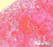 【病例】左肾撕裂伤伴包膜下血肿1例CT 【病例】左肾撕裂伤伴包膜下血肿1例CT