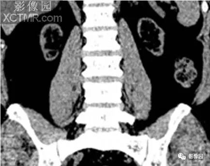 【病例】肾移植CT 【病例】肾移植CT