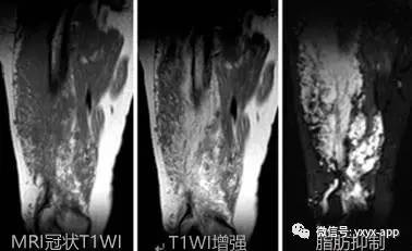 【病例】右侧大腿外侧血管瘤1例MRI影像表现