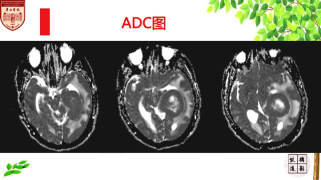 【病例】脑室内脑膜瘤1例MR影像表现 【病例】脑室内脑膜瘤1例MR影像表现